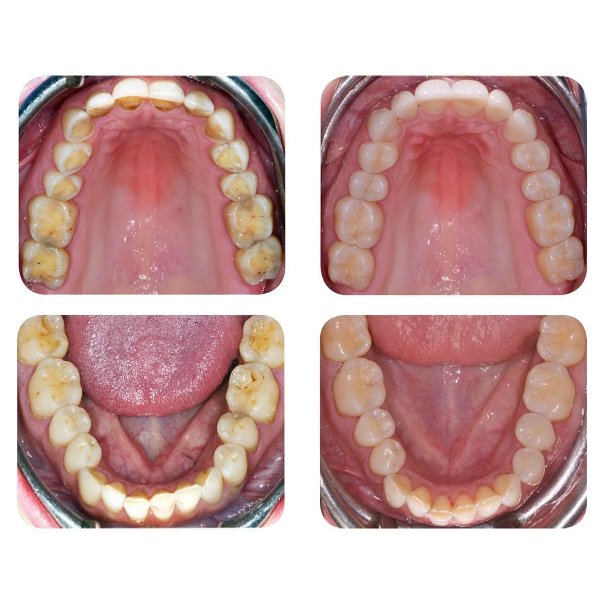 Enamel Plus HRi Bio Function glazuurmassa - Kit - CR3FB, 3 spuitjes 2,5g (elk 1 BF1, BF2, BF3)