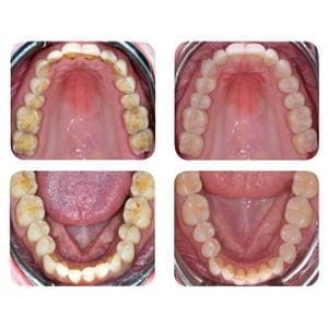 Enamel Plus HRi Bio Function glazuurmassa - Kit - CR3FBT, Tips elk 6 x 0,3g (BF1, BF2, BF3)